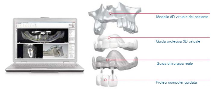 Il flusso della chirurgia computer guidata: modello 3D del paziente, guida protesica virtuale, guida chirurgica reale e protesi
