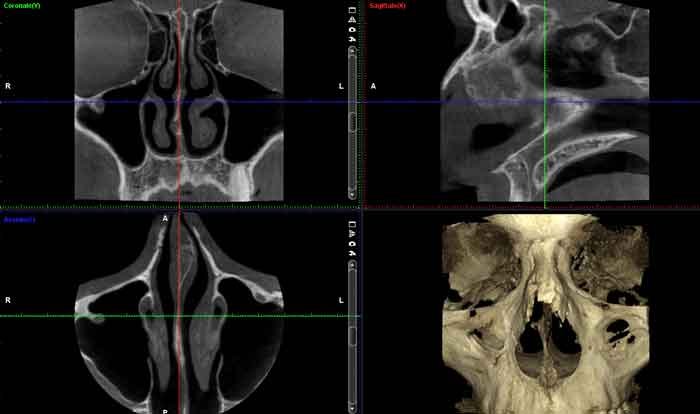 Sezioni TC Cone Beam delle cavità nasali e paranasali con ricostruzione 3D