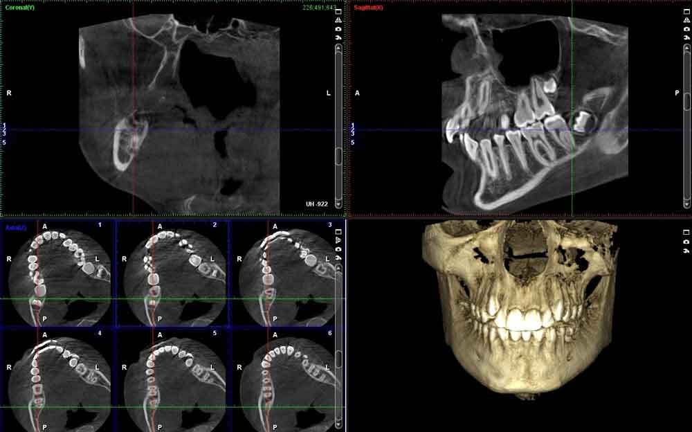 Immagini TC Cone Beam dei mascellari con sezioni e ricostruzione tridimensionale del cranio