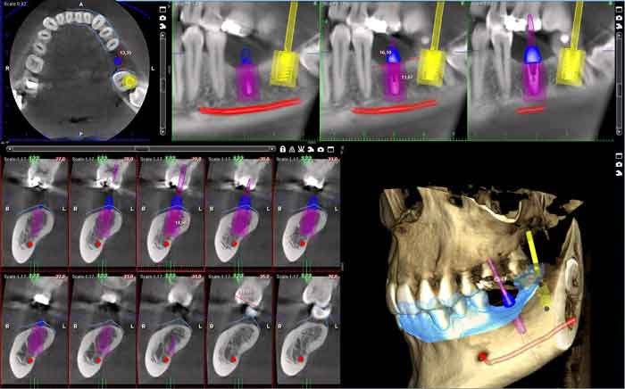 Pianificazione di impianti dentali su immagini TC Cone Beam con modello 3D della mandibola