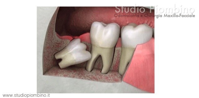 Illustrazione di un dente del giudizio inferiore inclinato contro il secondo molare