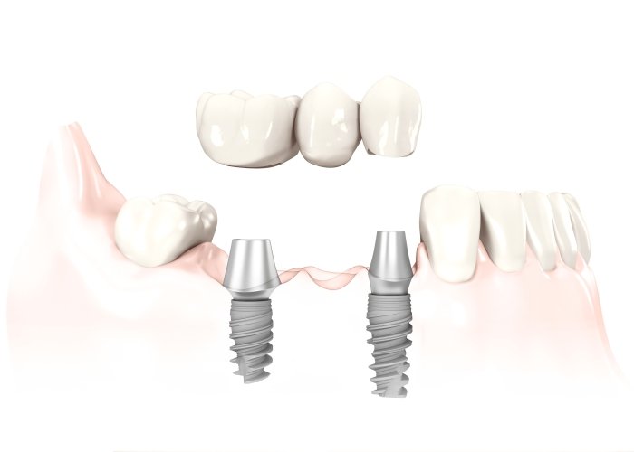 Illustrazione di un ponte di tre denti fissato su due impianti