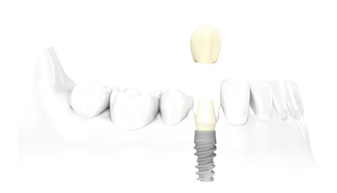 Illustrazione di un impianto dentale con corona inserito tra due denti naturali