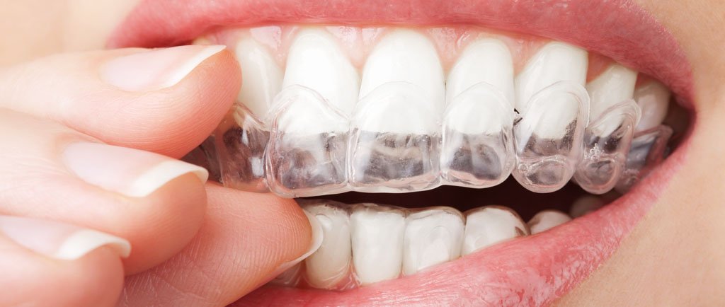 Mascherina trasparente per l'allineamento dei denti applicata sull'arcata superiore