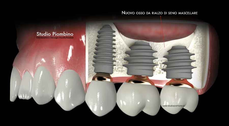 Illustrazione di impianti inseriti nel nuovo osso ottenuto con il rialzo del seno mascellare