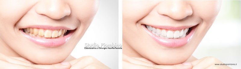 Sorriso prima e dopo lo sbiancamento dentale