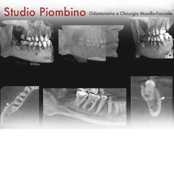 Immagini TC Cone Beam dei mascellari e dei denti