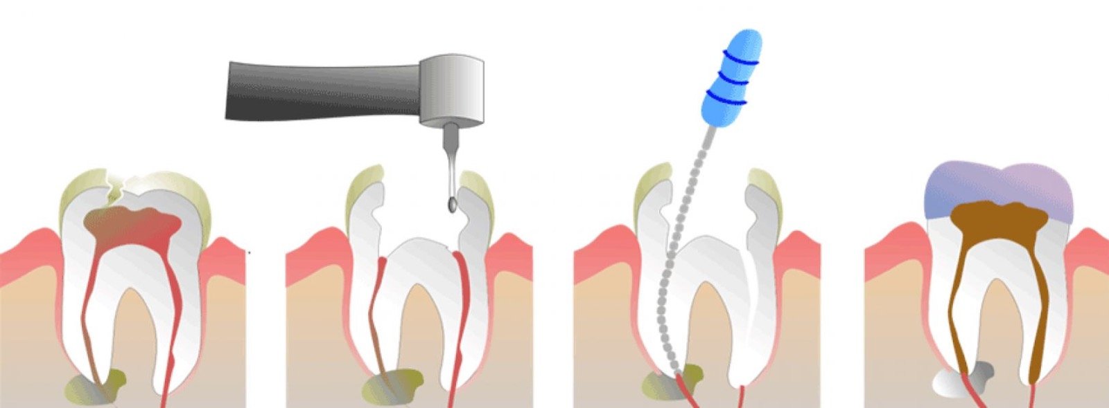 Schema delle fasi della terapia canalare: dente infetto, apertura, pulizia dei canali e otturazione